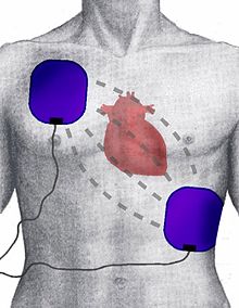 220px Defibrillation Electrode Position